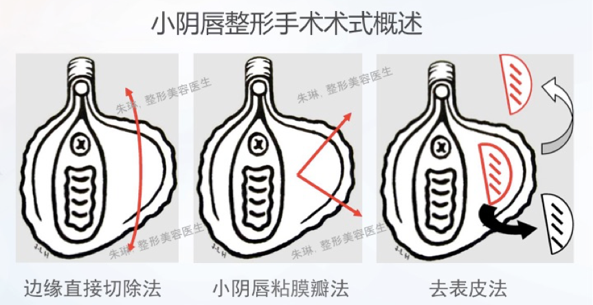(3)阴蒂包皮:阴蒂包皮过长会损伤美观,还会影响个人卫生,同时可能影响