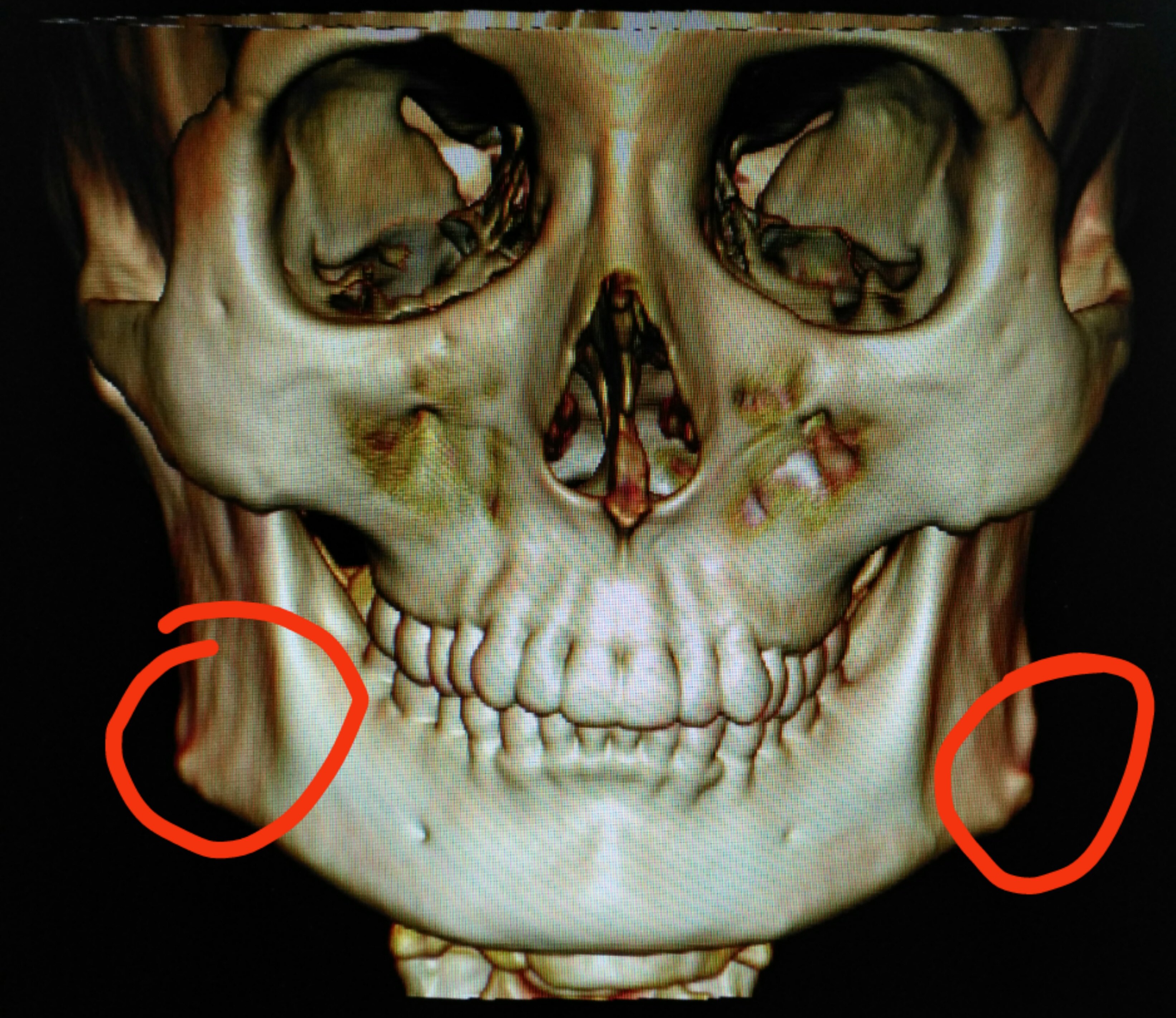 下颌骨ct图片