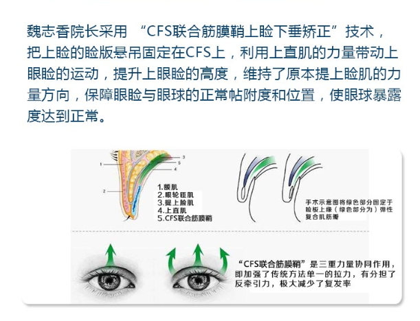 提肌缩短 额肌悬吊 cfs联合筋膜鞘该怎么选择?