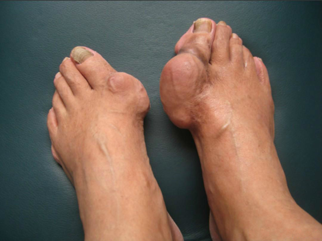 好大两颗蚕豆大爷多年为何都是打赤脚过冬