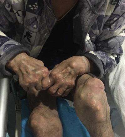 如何处理痛风急性发作_王振清_主治医师_爱问健康