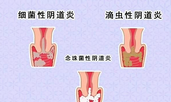 患滴虫性阴道炎能否怀孕?