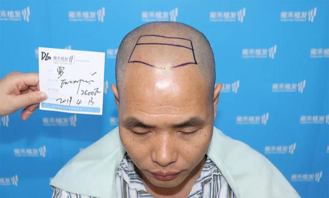 秃头改善案例