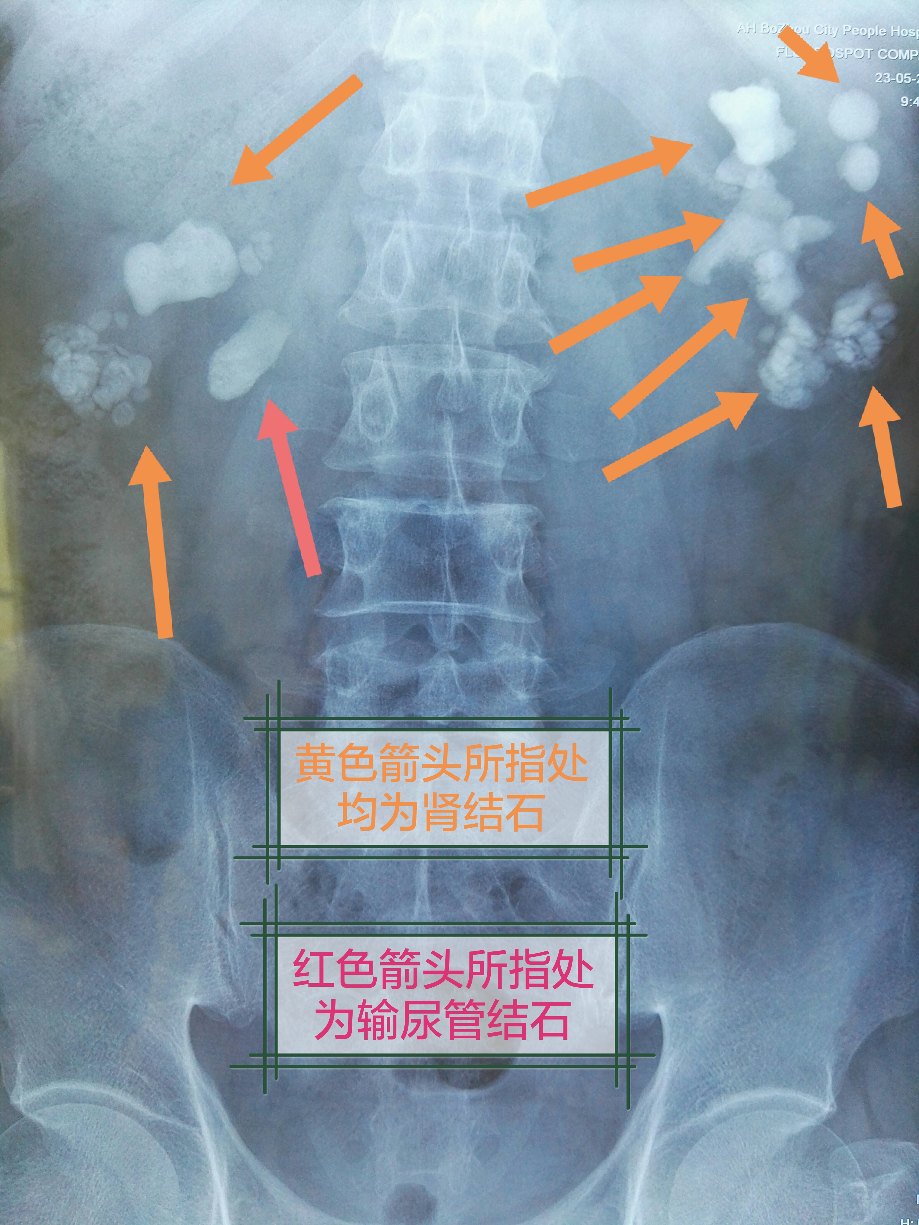 腎結石的外科治療包括經皮腎取石術,體外衝擊波碎石術,輸尿管軟鏡手術