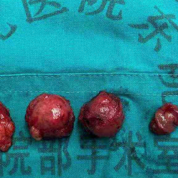 一例经尿道前列腺切除术后膀胱颈挛缩手术