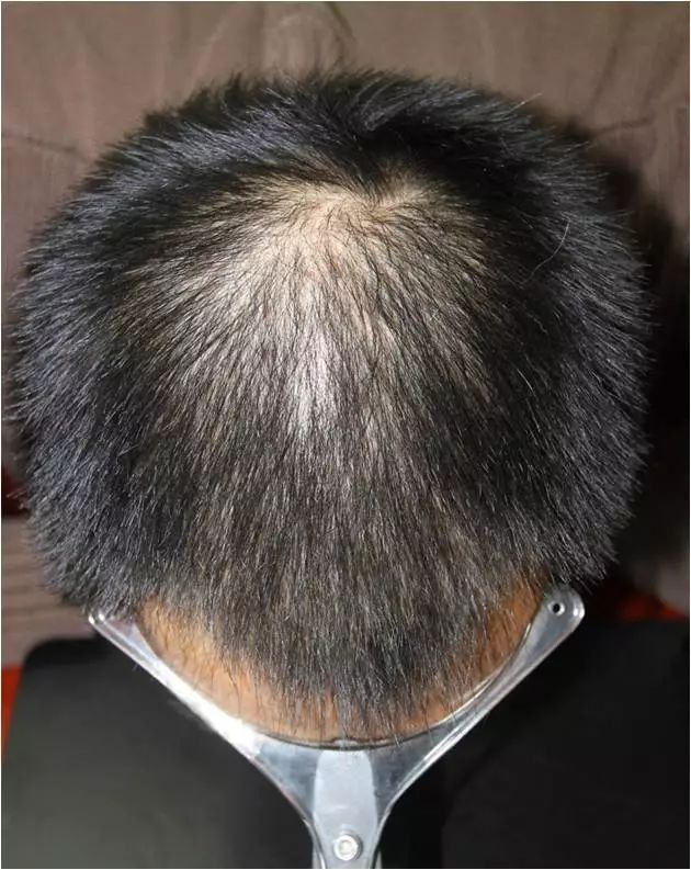 雄激素性秃发治疗方式及临床表现