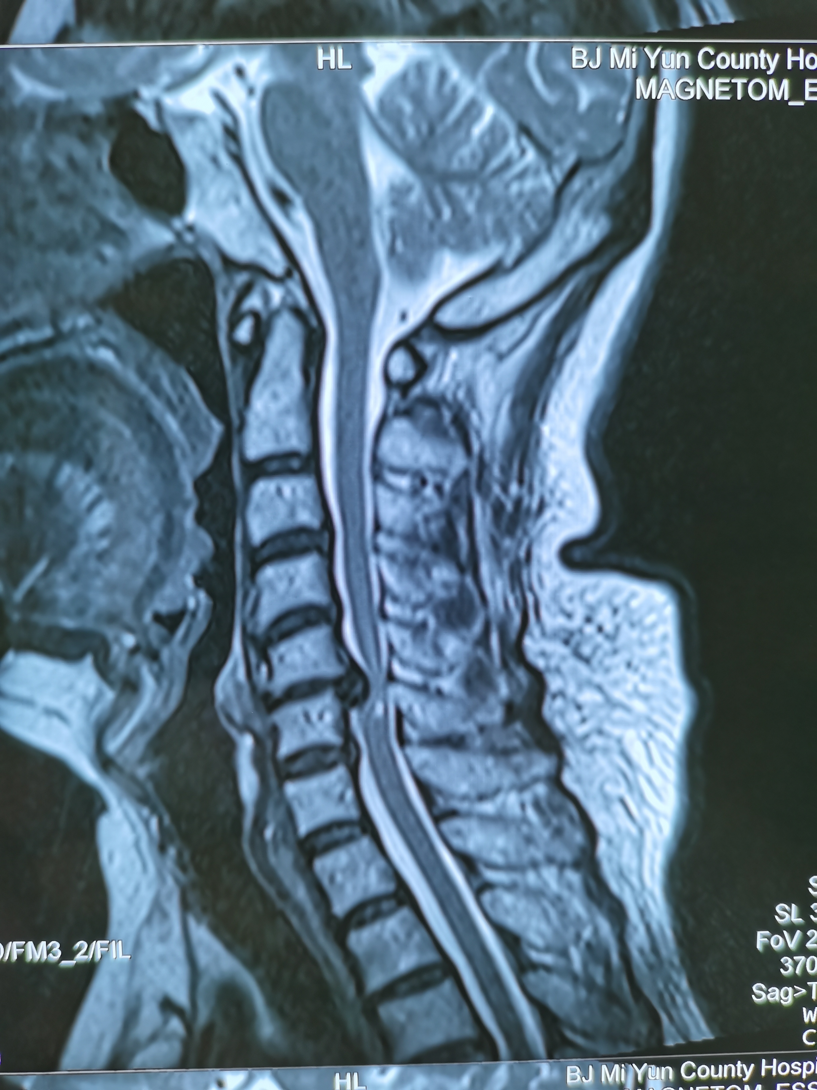 颈椎后纵韧带骨化症