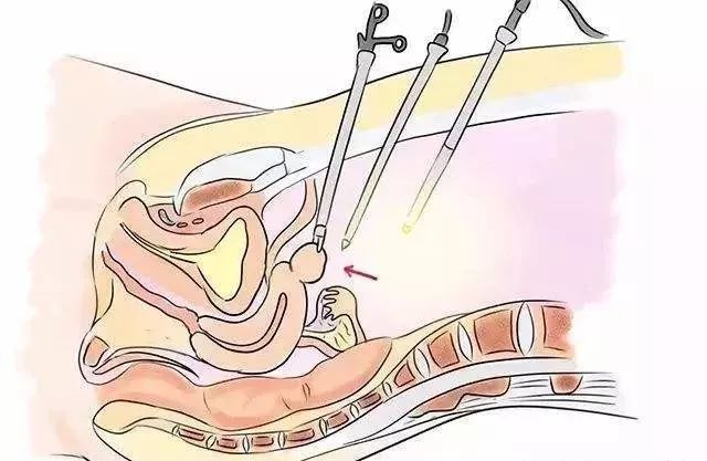 腹腔镜疏通输卵管图片