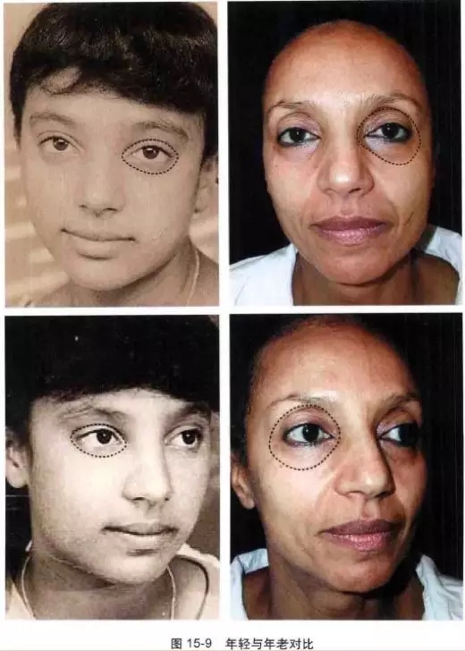 眼周凹陷让你老了十岁