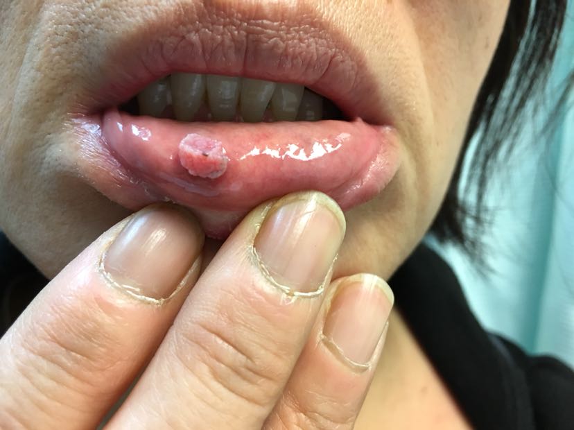 口唇上的hpv感染