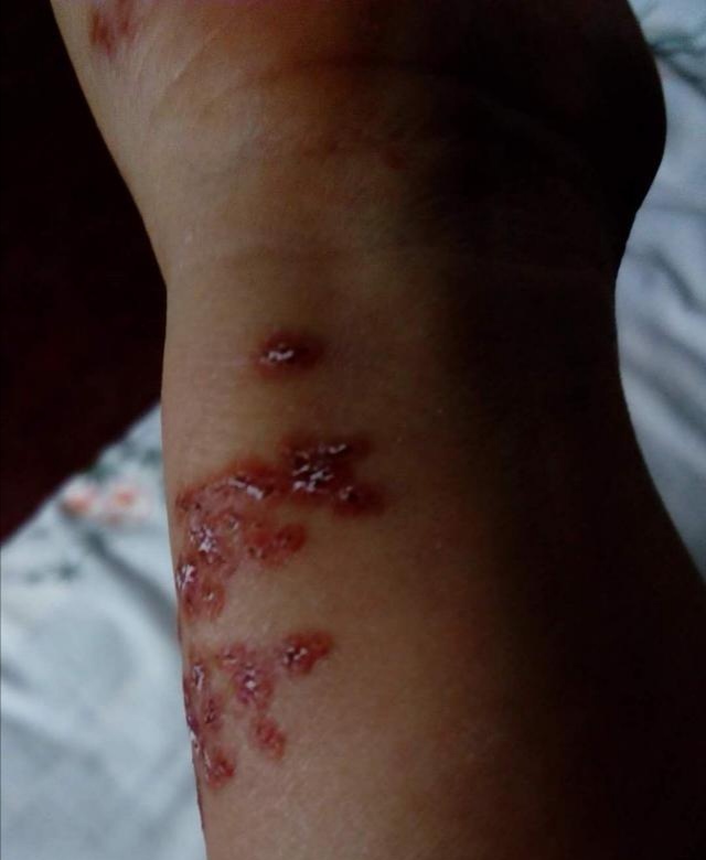 手上长的是带状疱疹吗?-商进副主任医师-爱问医生