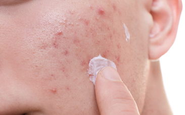 油痘肌肤反复长痘怎么办?