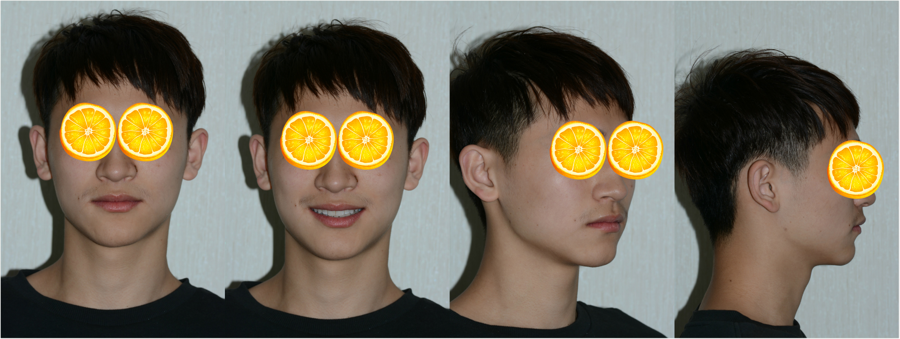 蜕变:牙套偶像初长成!