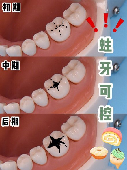 龋齿洞型分类6类图片