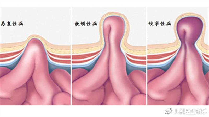 婴儿疝气图片图解图片