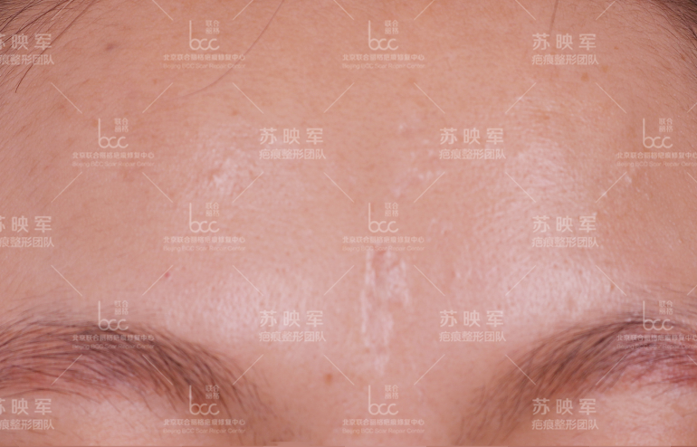 "女二郎神"眉心凹陷疤痕修复后续