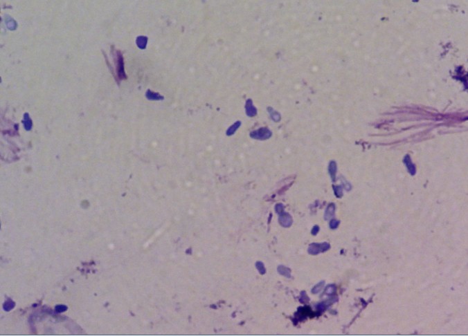 一种叫马拉色菌的真菌可能会在头皮表面大量繁殖,刺激头皮细胞分泌