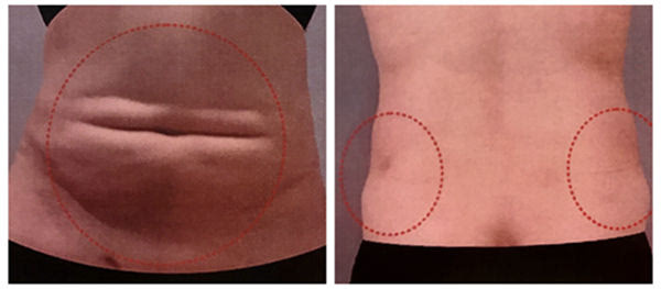 陈万芳讲脂肪:吸脂失败后能修复吗?