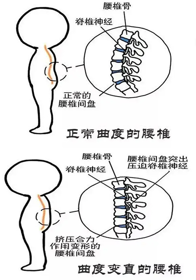 正常腰椎形状图片大全图片