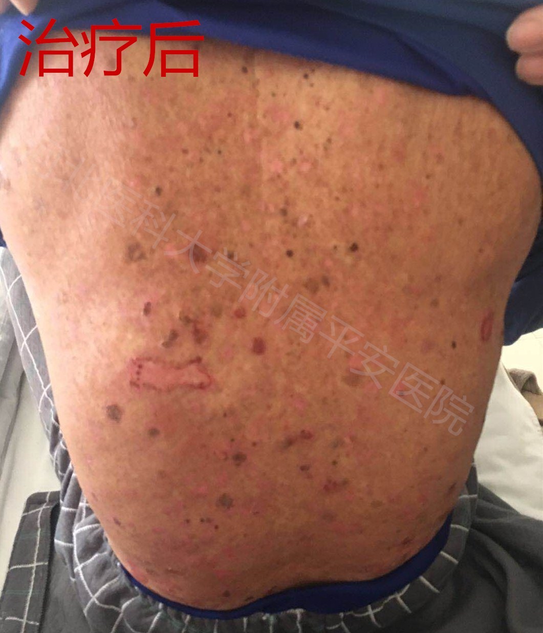 大疱性类天疱疮老人康复出院中西医结合发挥治疗优势