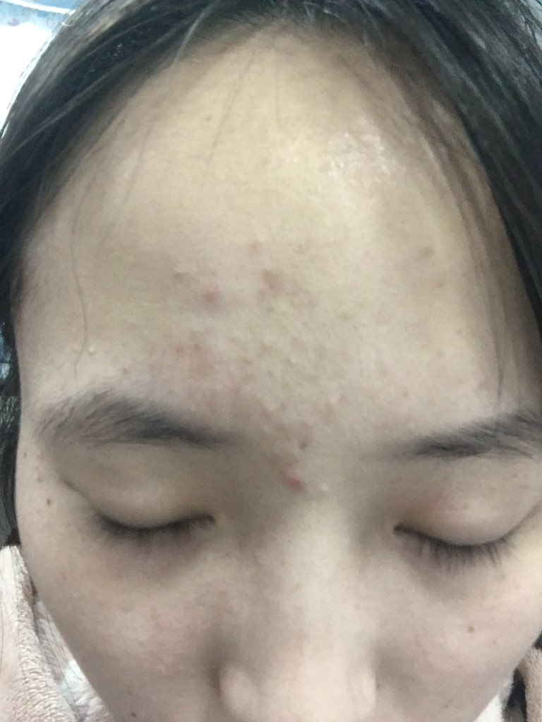 只是额头有痘痘怎么解？（咨询）