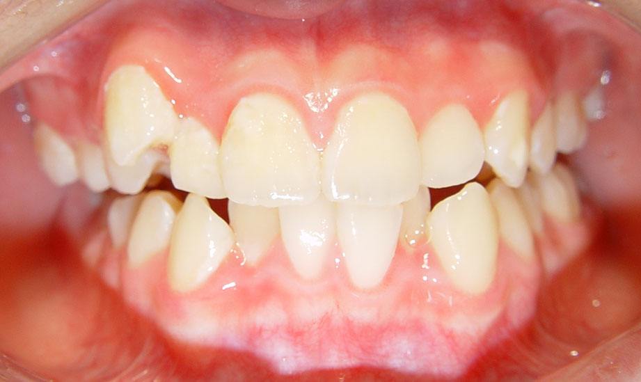 前牙的正中线向一侧错位从而导致后边的牙齿形成刃对刃,尖对尖的咬合