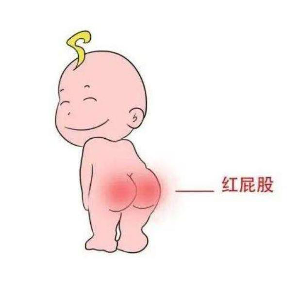 儿童尿布疹红屁股这样合理用药正确护理