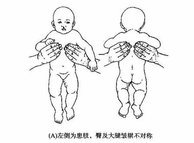 警惕宝宝的这些表现可能是先天性髋关节脱位