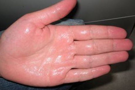 的,是先天性的;继发性手汗症是少数人因为身体器官疾病造成出汗量增加