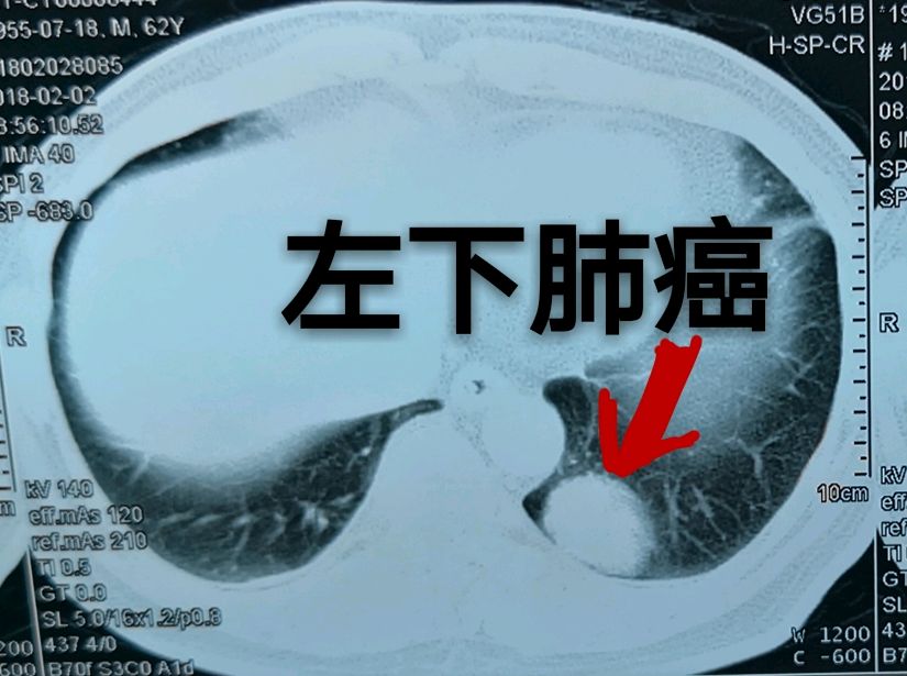 有肿瘤病史的人一定要提防肺癌!