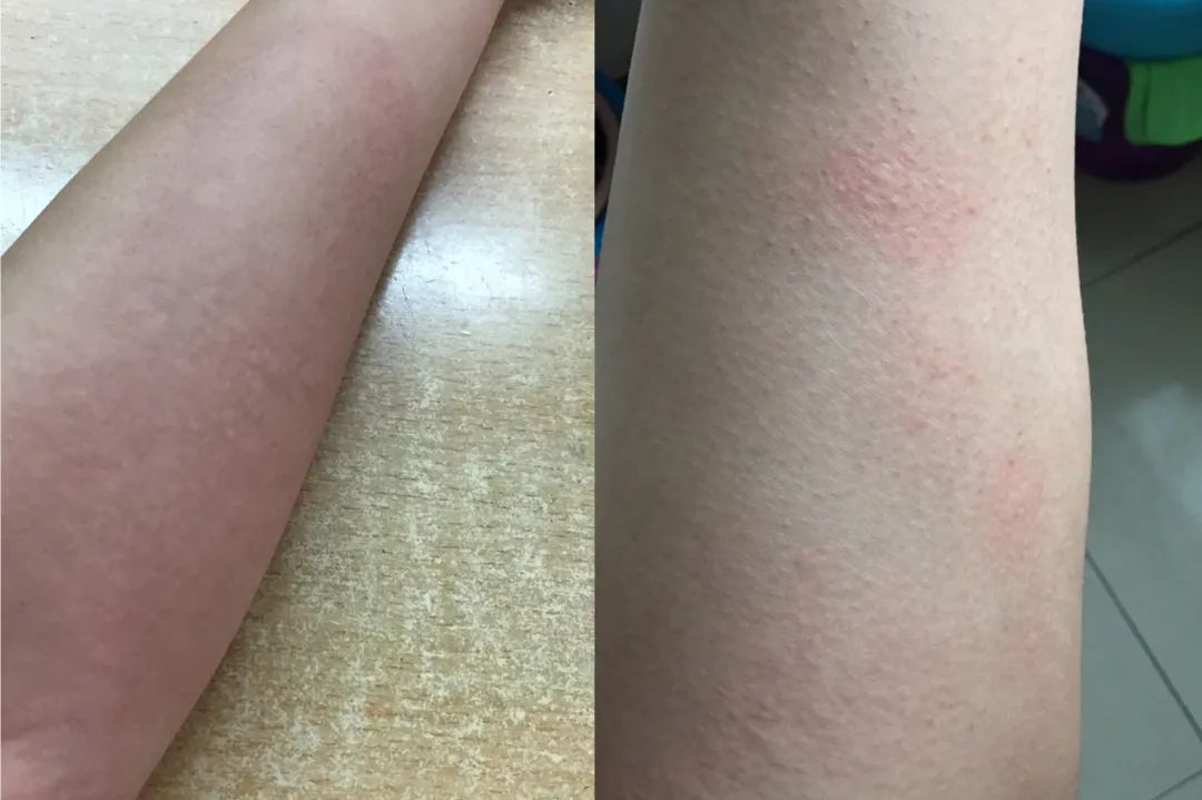 甲亢女生脖子iii度肿大,吃药严重过敏,白细胞骤降!