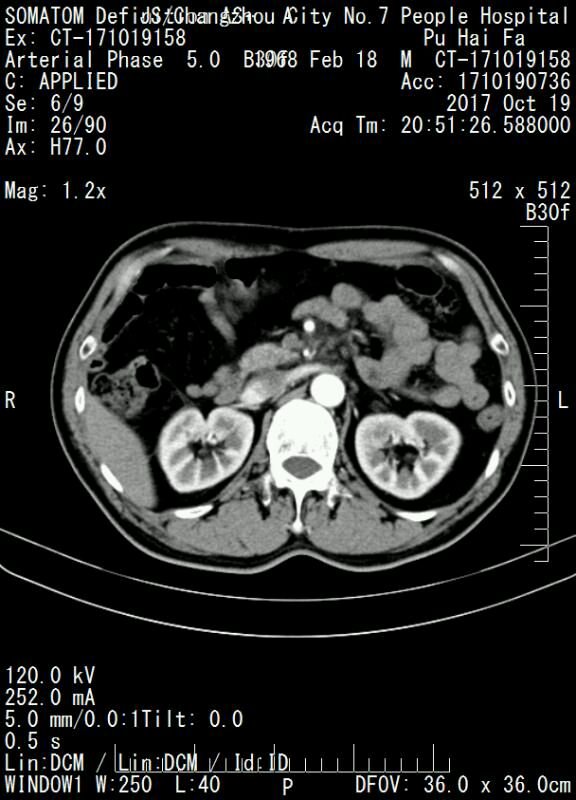 肠系膜上动脉夹层图片