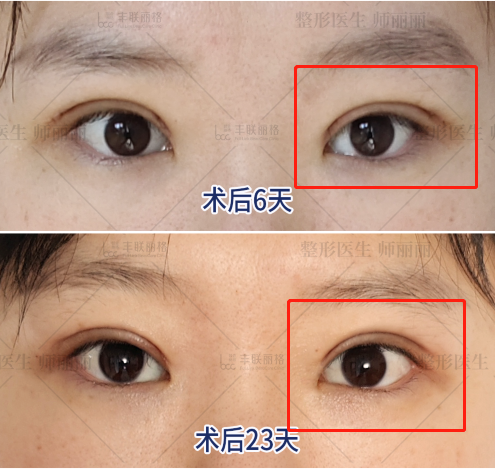 师丽丽眼修复丨双眼皮多层褶/多层眼皮可以进行修复吗?