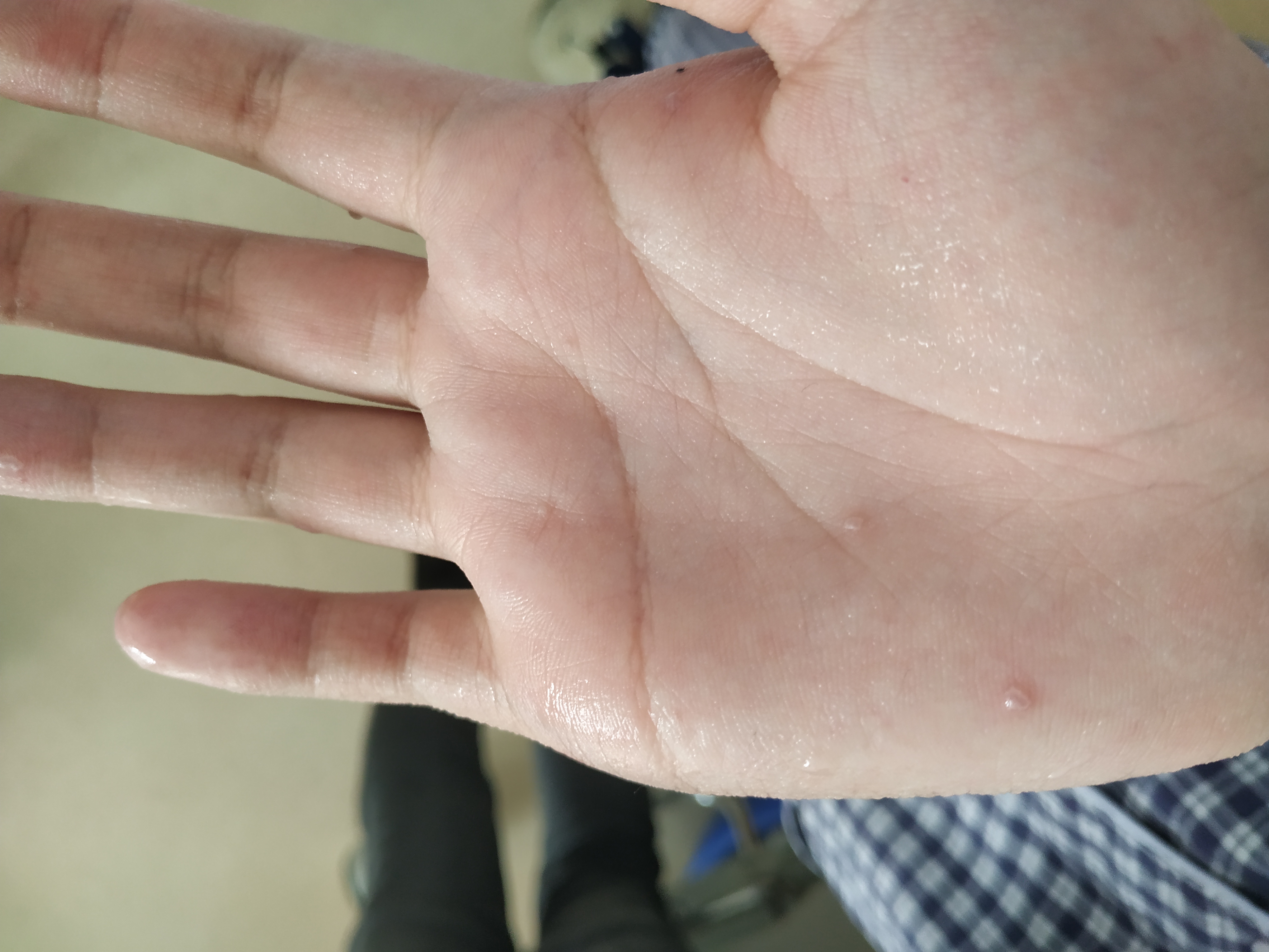 手上容易冒汗滴是怎么回事呢