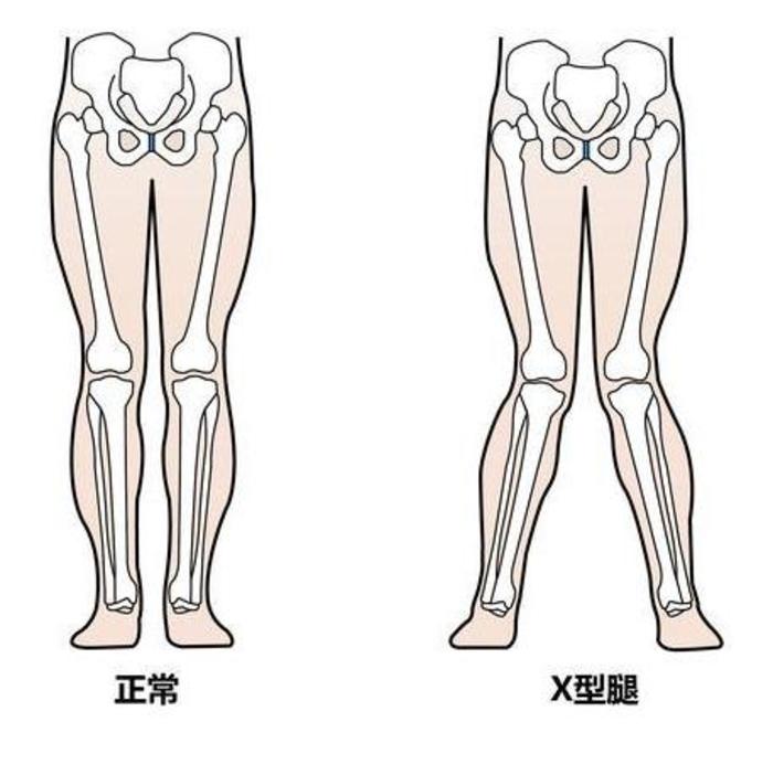 ox型腿和正常腿照片图片