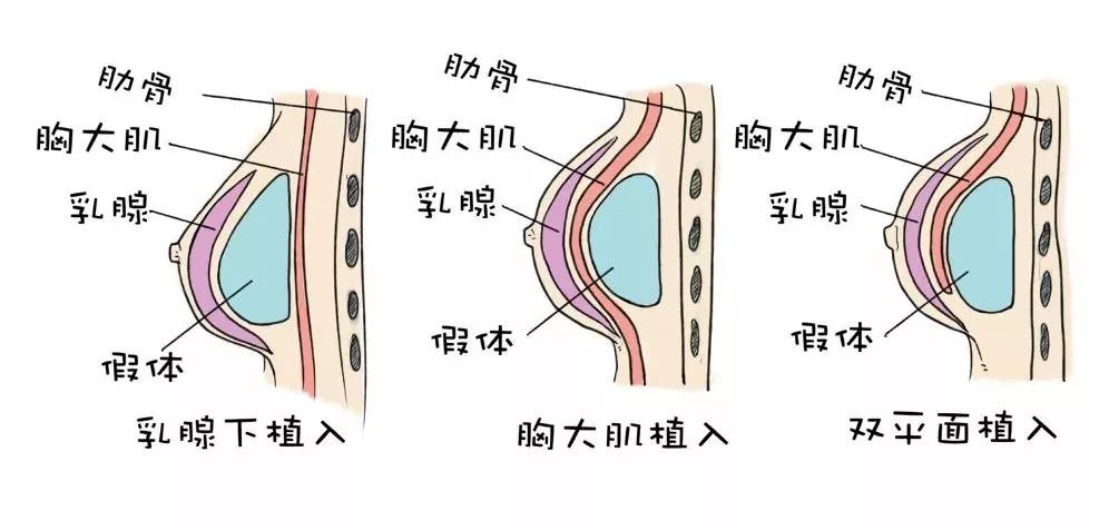 假体放置的位置 1