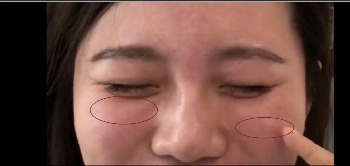 为什么我不建议你的泪沟注射玻尿酸?因为注射后,黑眼圈加深了