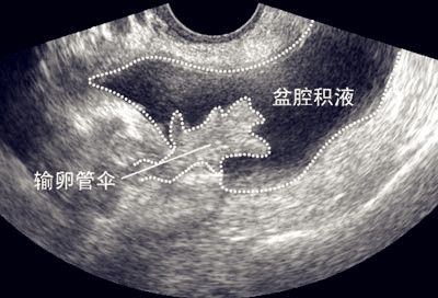 盆腔积液怎么引起的?