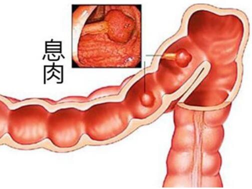 女人肛门长息肉处长图片