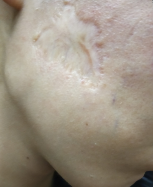 脸部疤痕修复 脸部疤痕哪种修复方法效果最好?