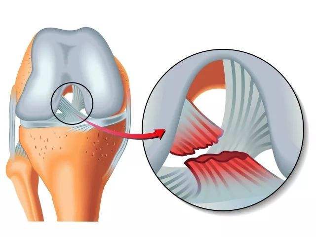 科普:前叉韧带断裂后,医生帮你接的韧带可能来自别人的尸体!