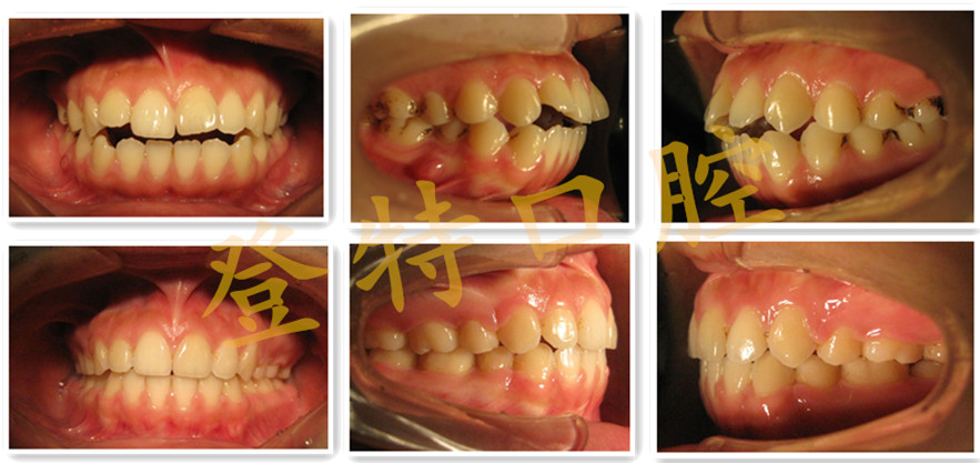 71【儿童反颌】由于经常允指,吐舌头等不良习惯导致的儿童牙齿问题