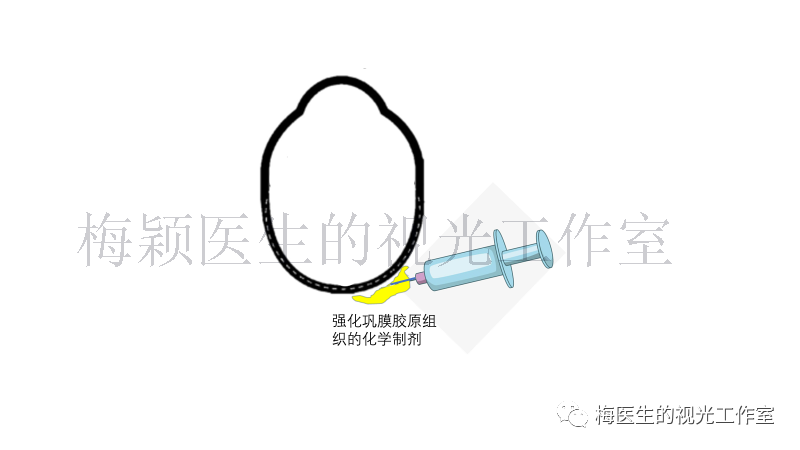 ssi是在眼球后极部的tenon囊下注射特殊的化学试剂(polyvinyl