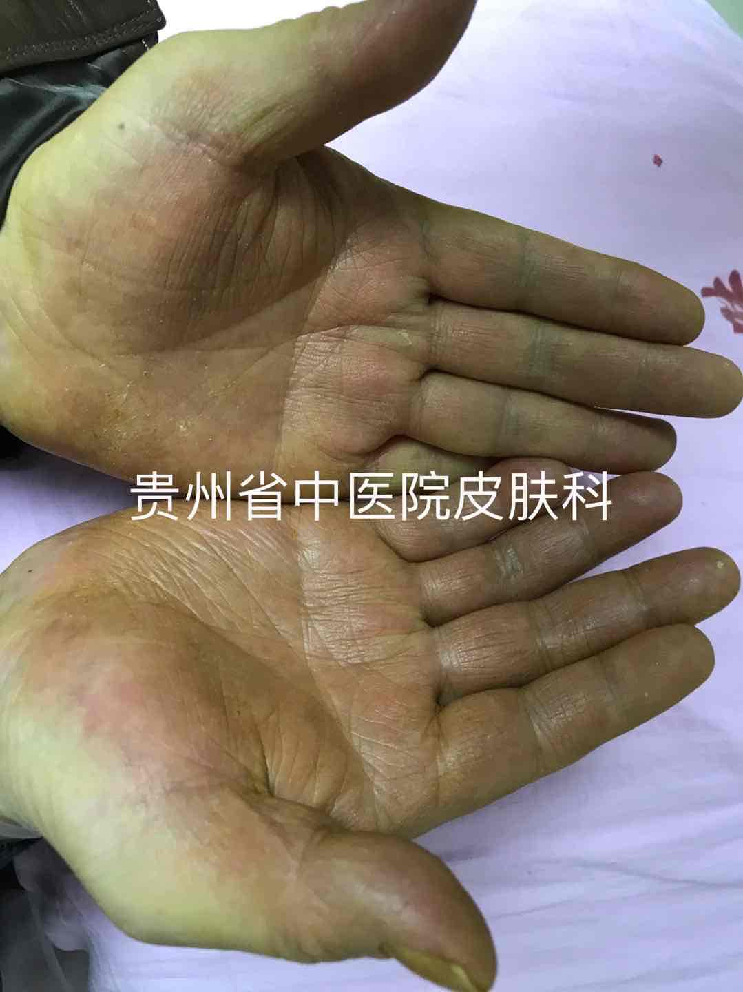 掌蹠膿皰病的皮疹侷限於掌蹠,其臨床特徵表現為在紅斑的基礎上發生