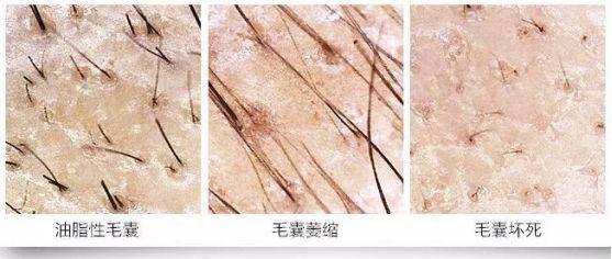 毛囊的状态