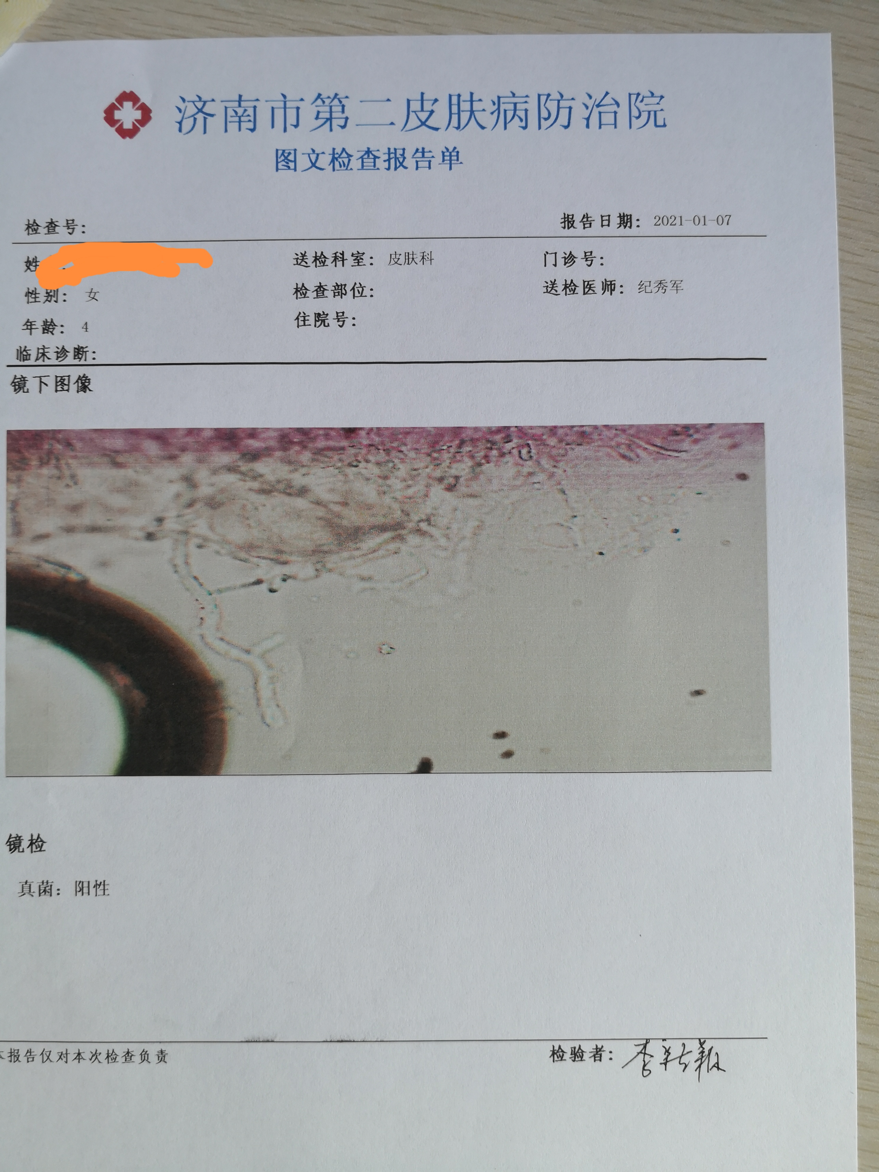 化验检查:真菌镜检阳性.