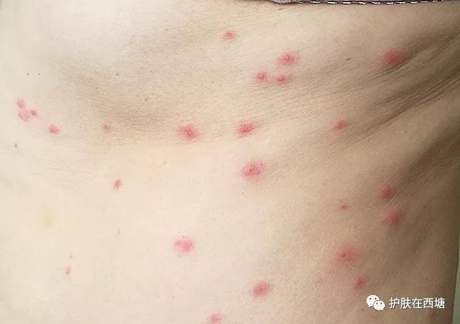 春节期间常见皮肤病(二):水痘和带状疱疹