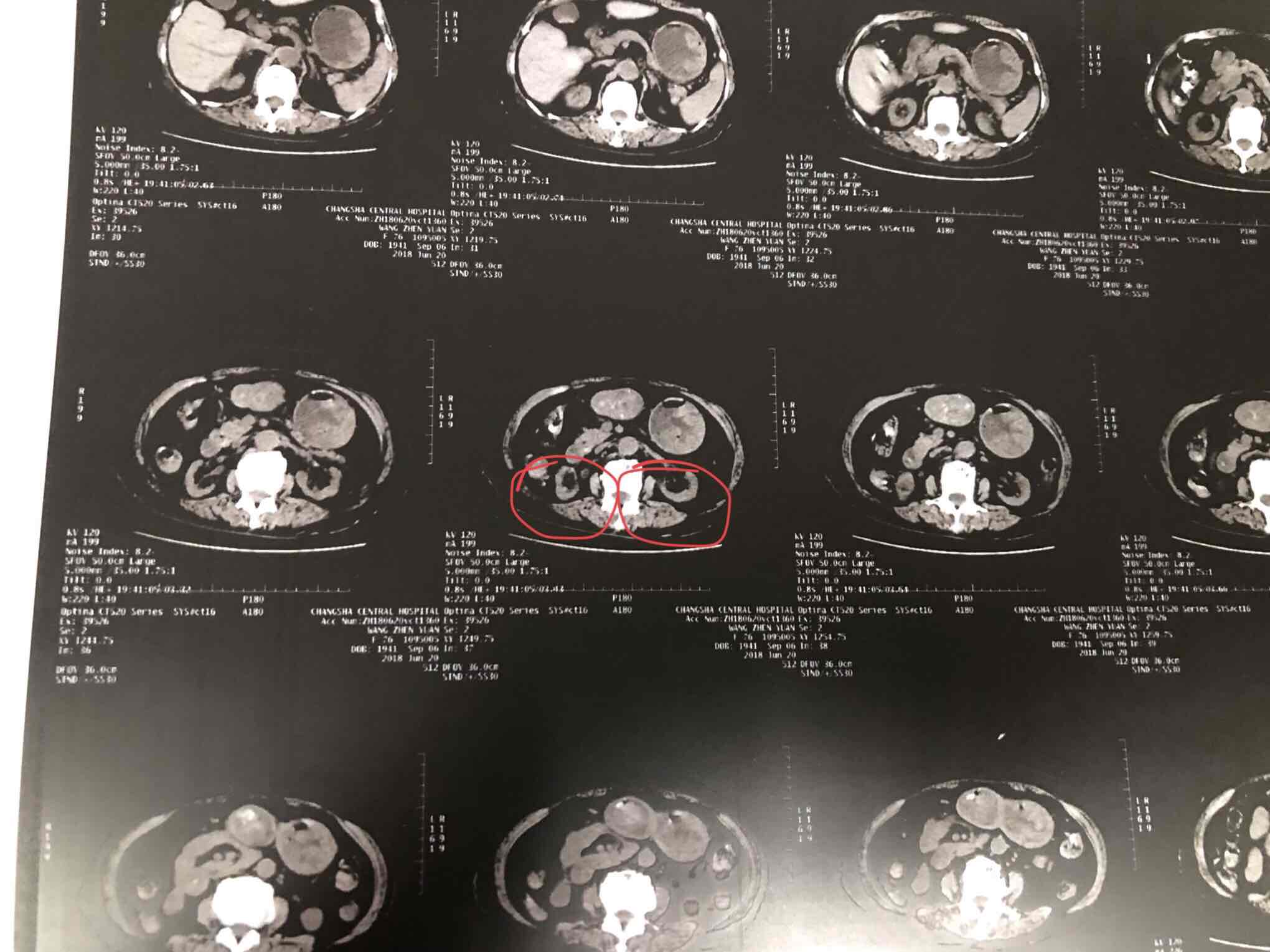 肾萎缩-邓洪-爱问医生