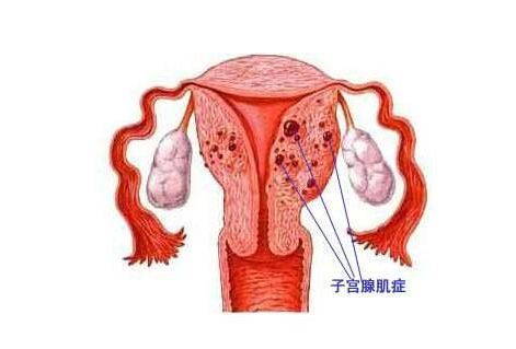 子宫腺肌症患者能不能运动呢?