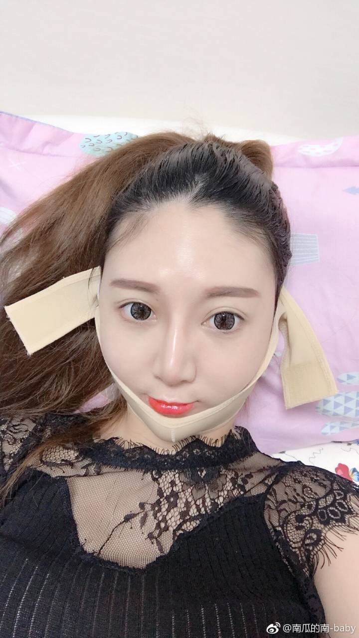 磨骨瘦脸下颌角削骨取咬肌手术第四天